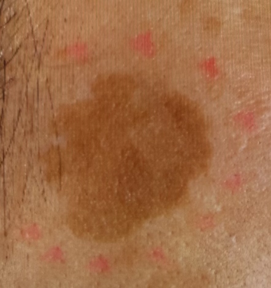 濃いシミ？大丈夫。